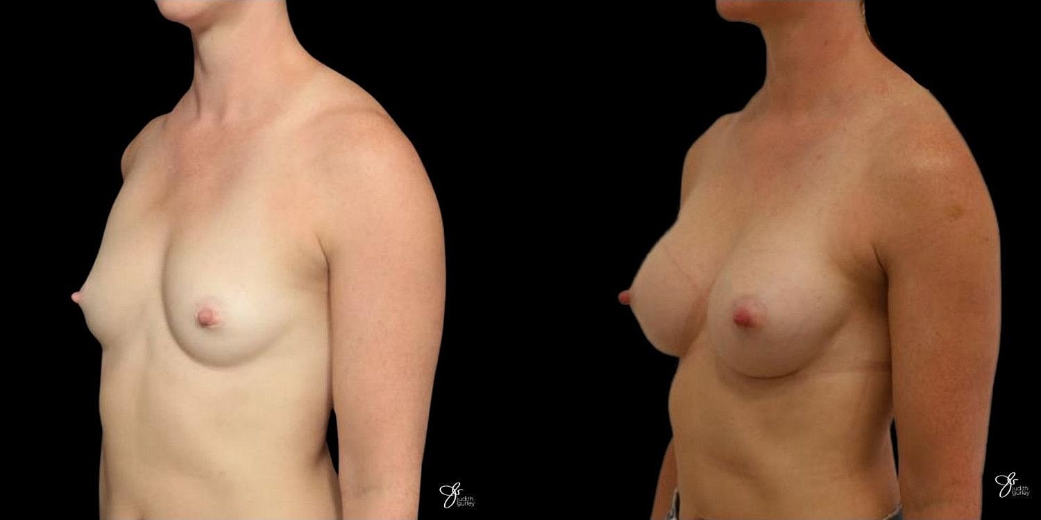 Motiva Breast Implants Before & After