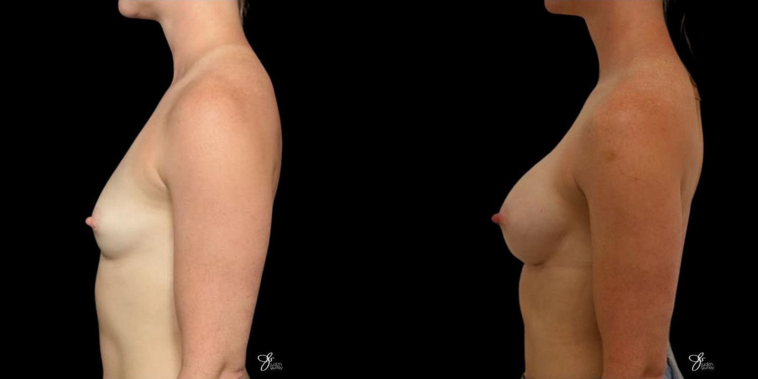 Motiva Breast Implants Before & After
