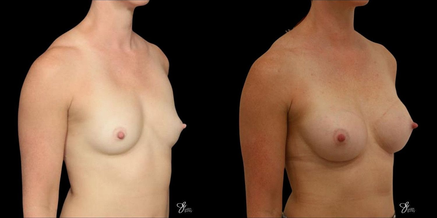 Motiva Breast Implants Before & After