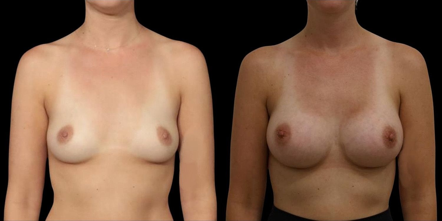 Motiva Breast Implants Before & After
