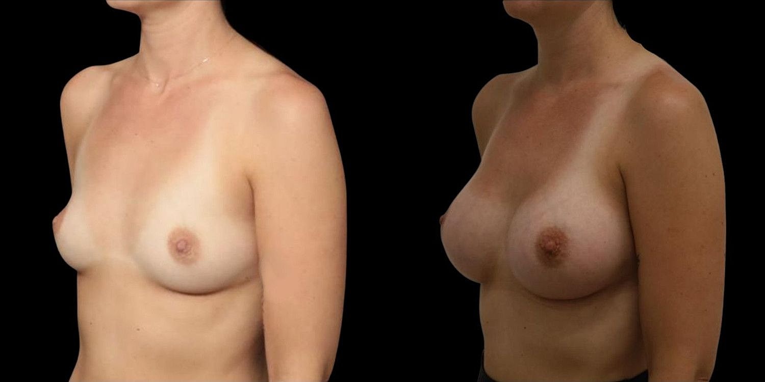 Motiva Breast Implants Before & After