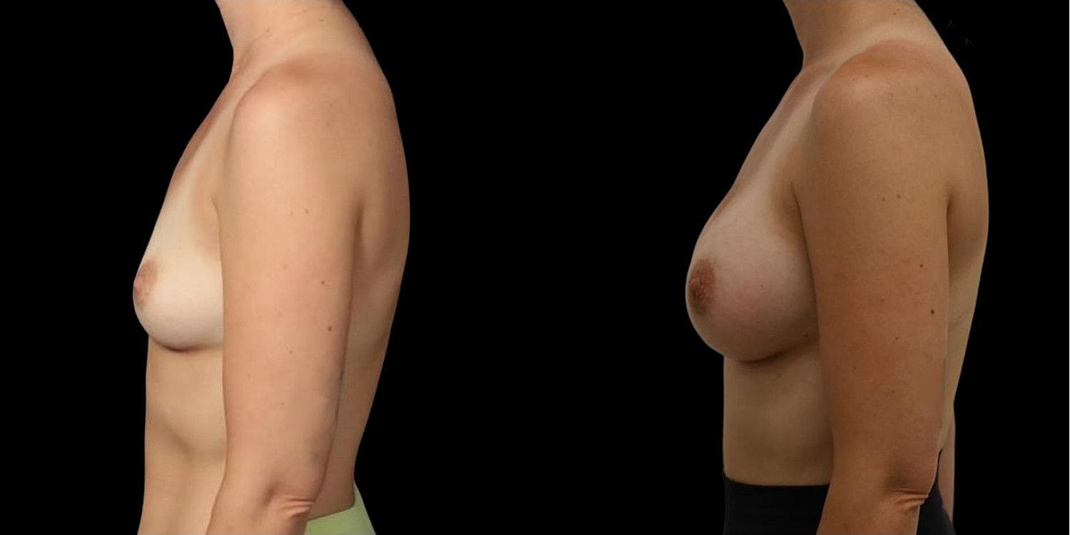 Motiva Breast Implants Before & After