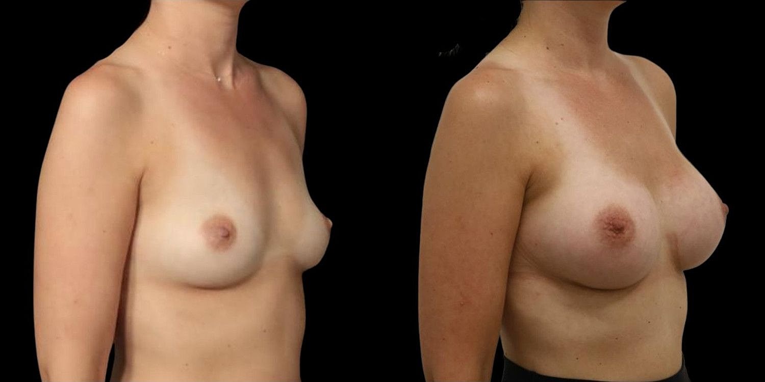 Motiva Breast Implants Before & After