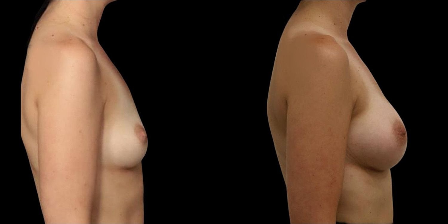 Motiva Breast Implants Before & After