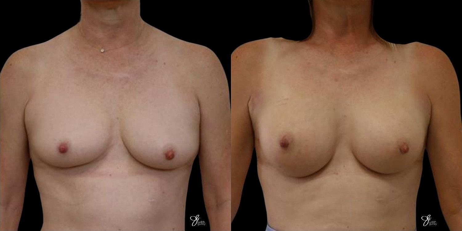 Motiva Breast Implants Before & After