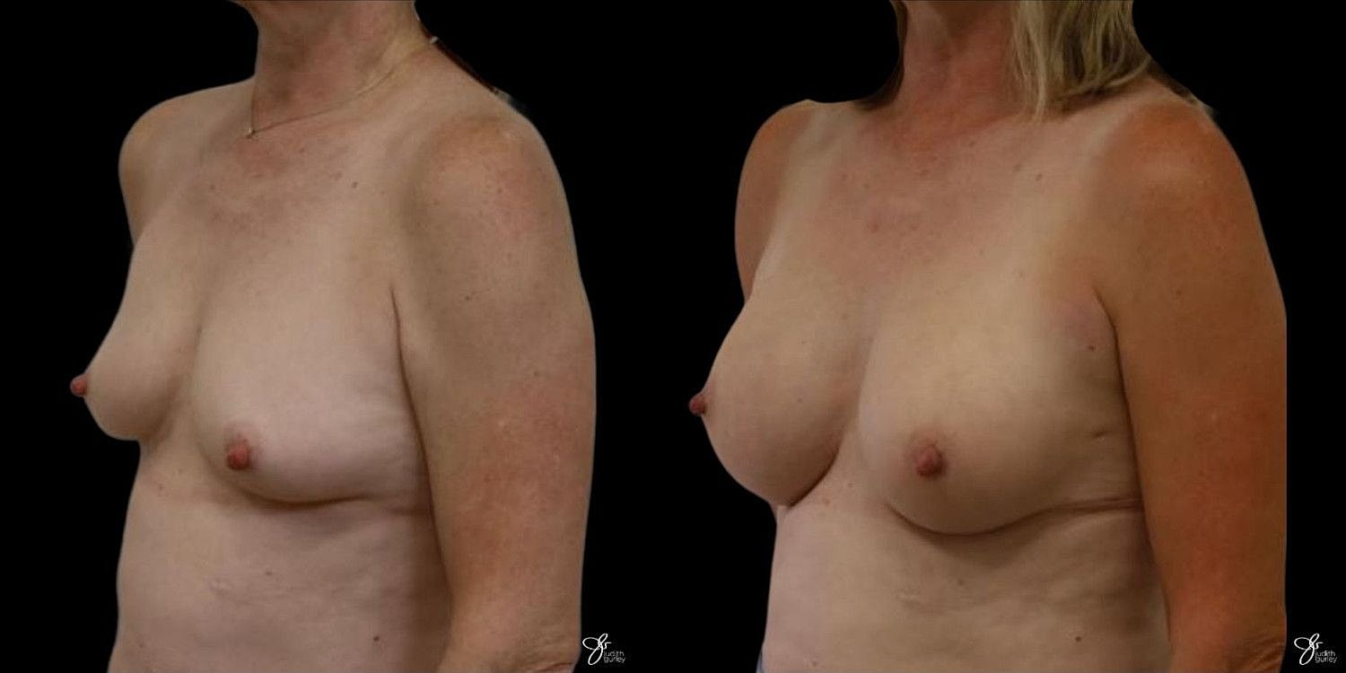 Motiva Breast Implants Before & After