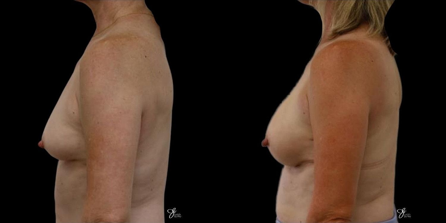 Motiva Breast Implants Before & After