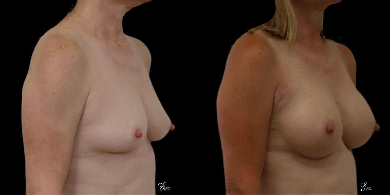 Motiva Breast Implants Before & After