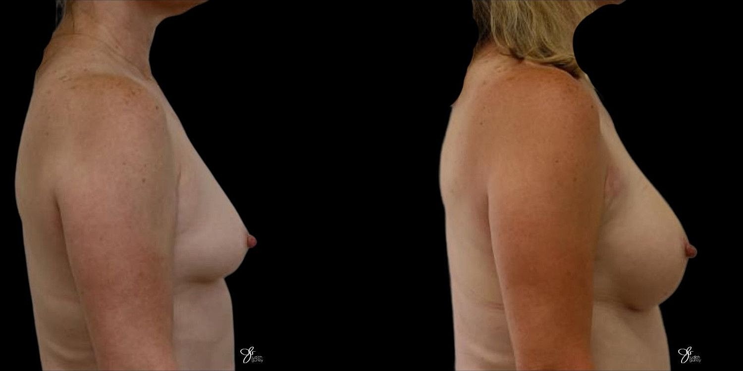 Motiva Breast Implants Before & After