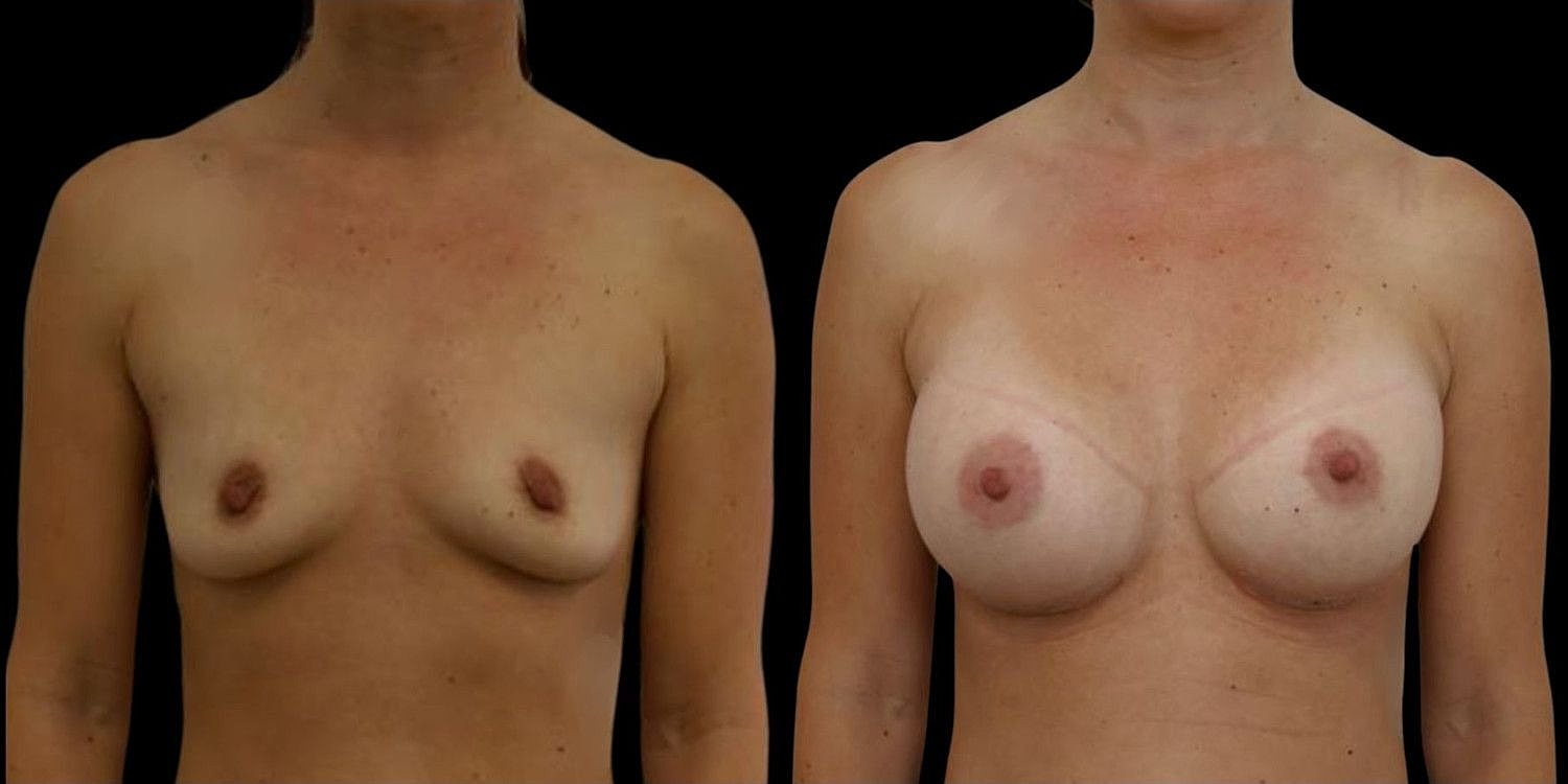 Motiva Breast Implants Before & After