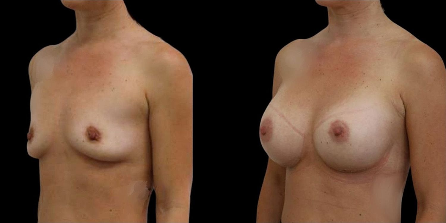 Motiva Breast Implants Before & After