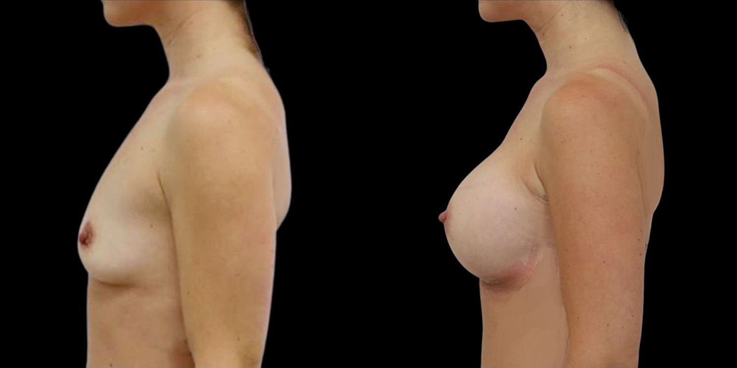 Motiva Breast Implants Before & After