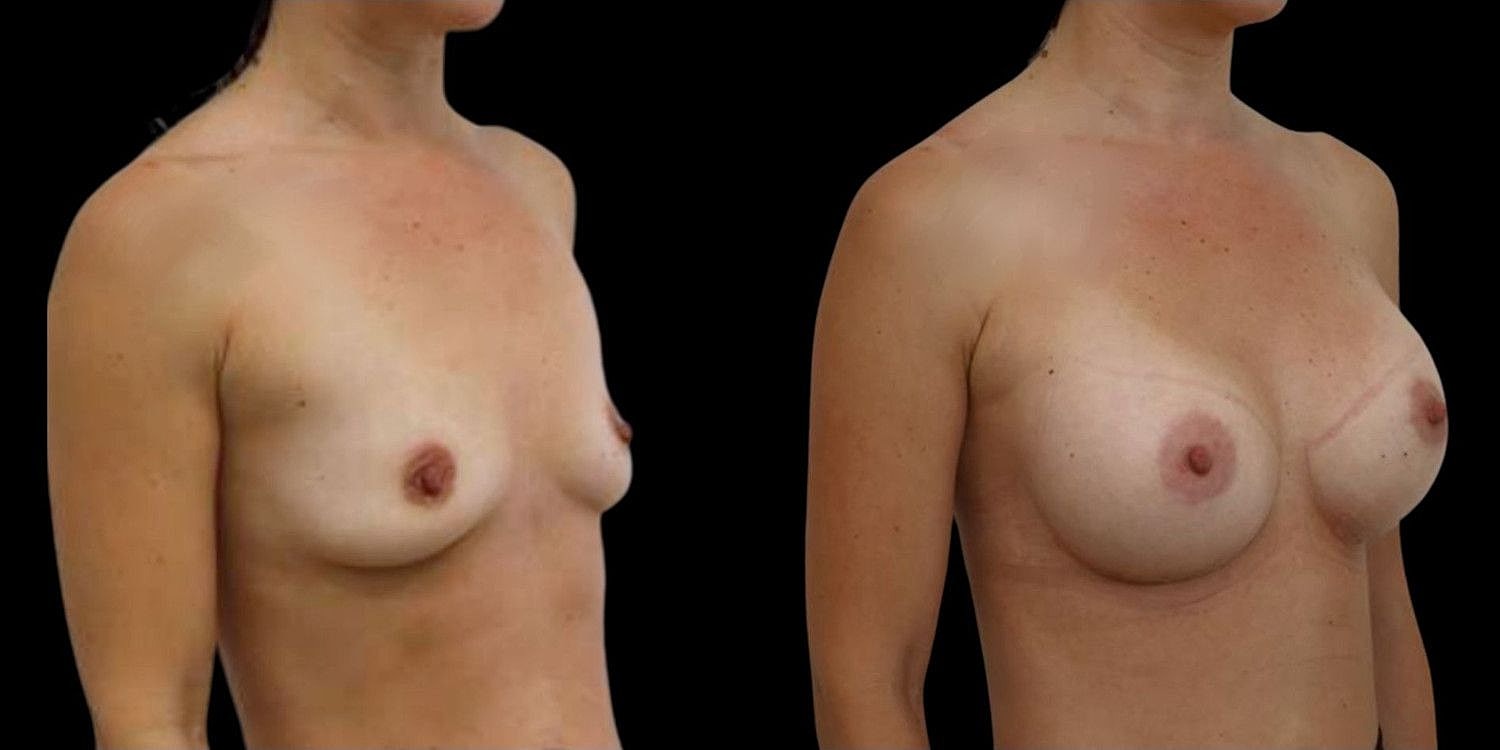 Motiva Breast Implants Before & After