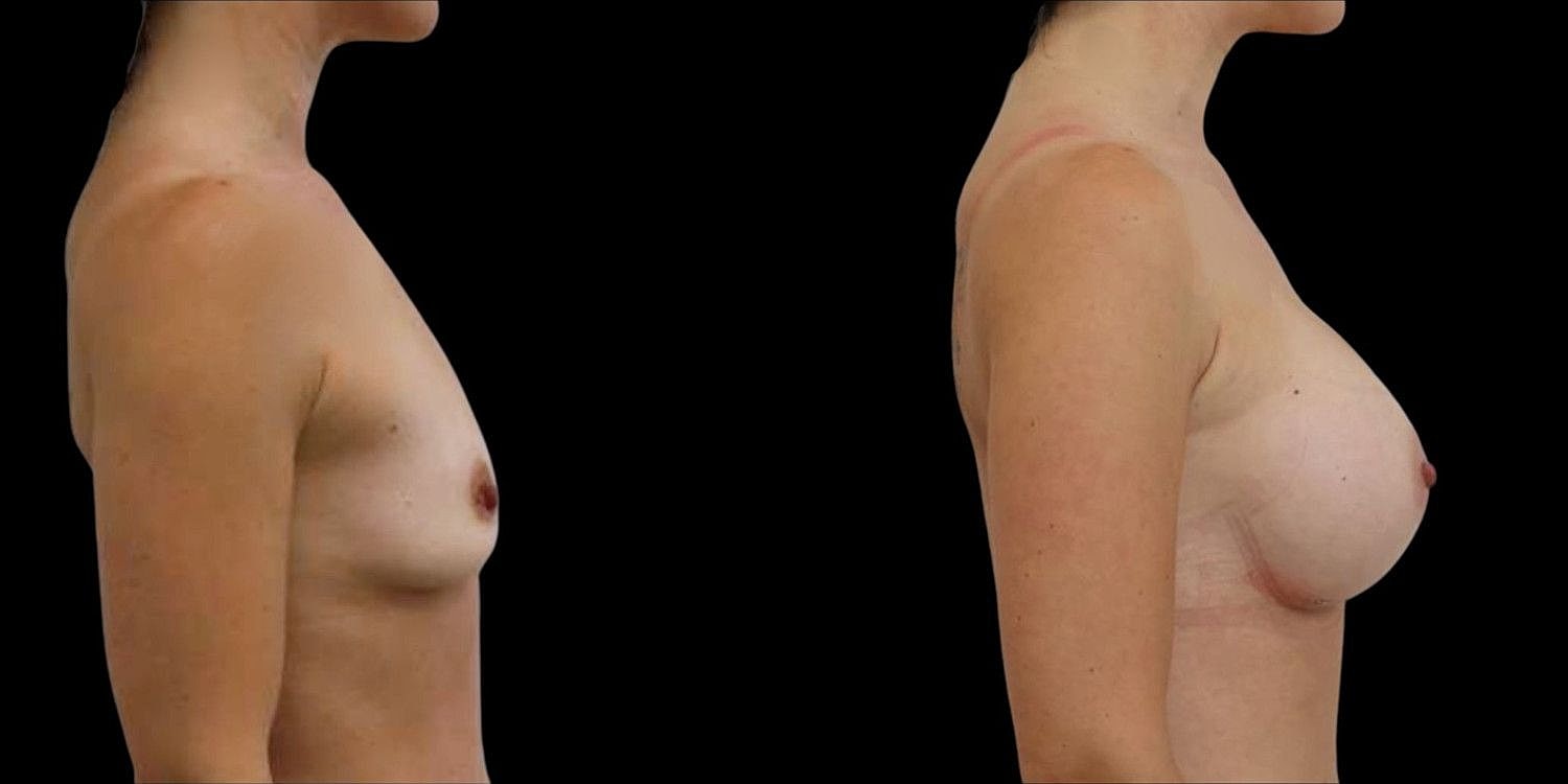 Motiva Breast Implants Before & After