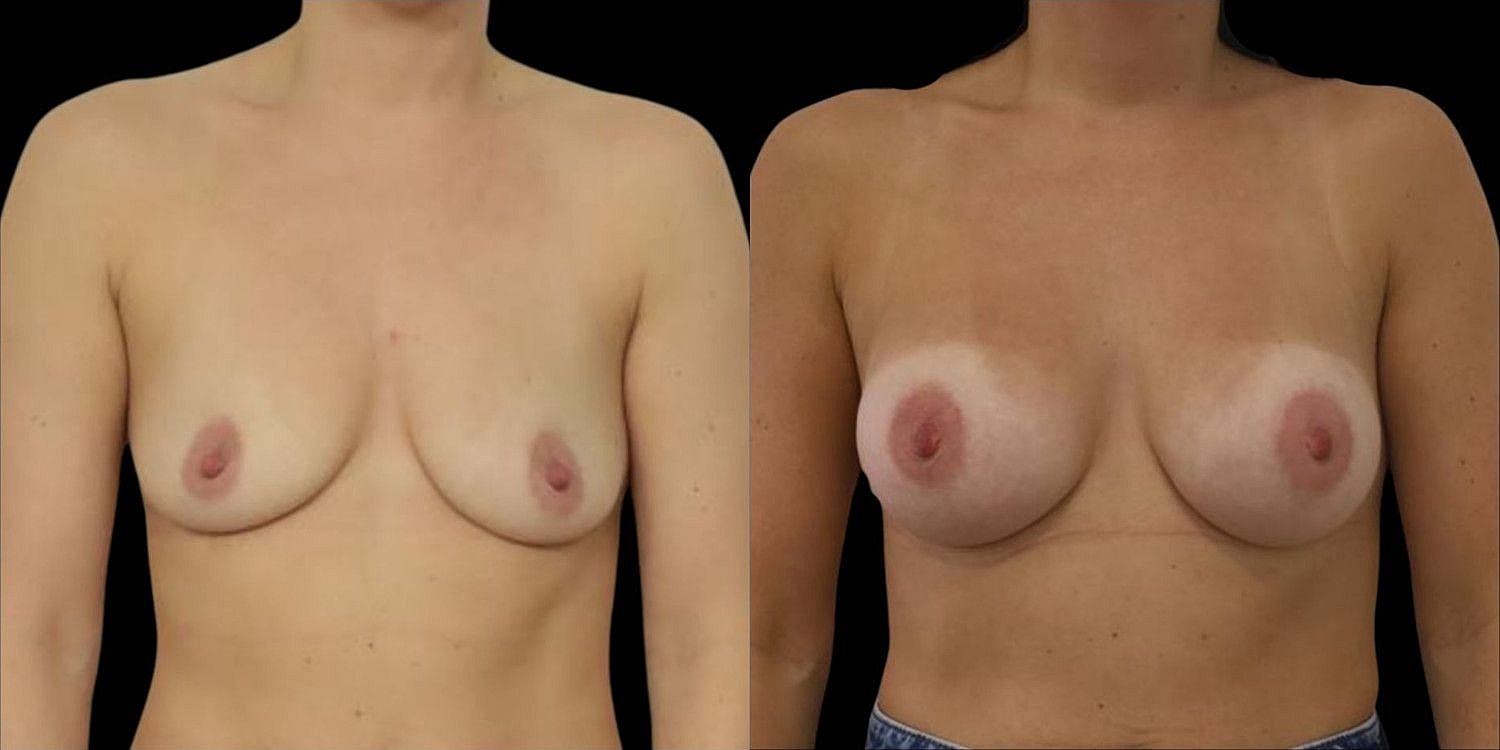 Motiva Breast Implants Before & After
