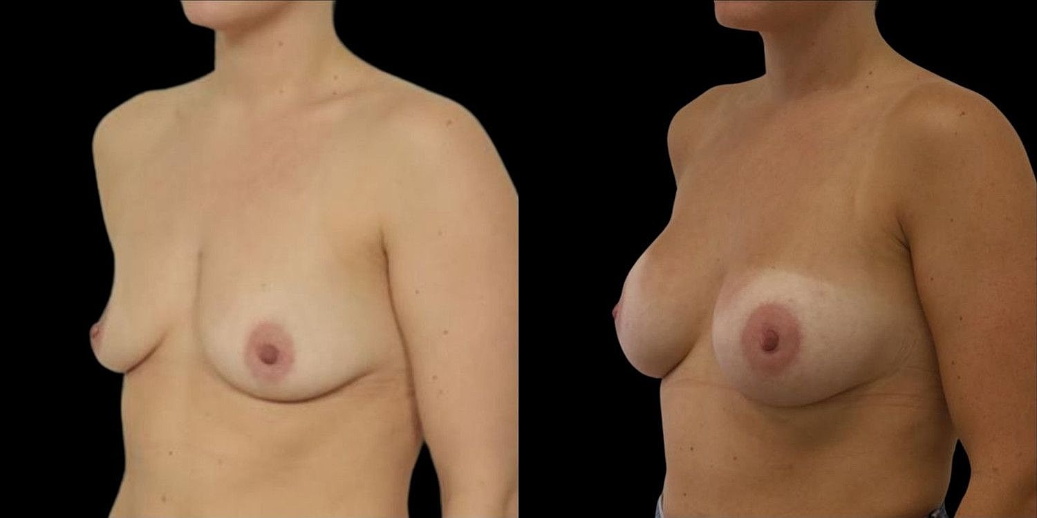 Motiva Breast Implants Before & After