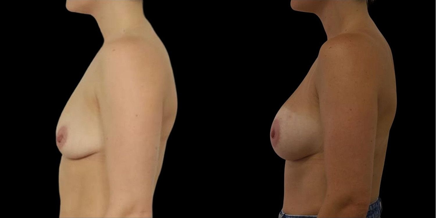 Motiva Breast Implants Before & After