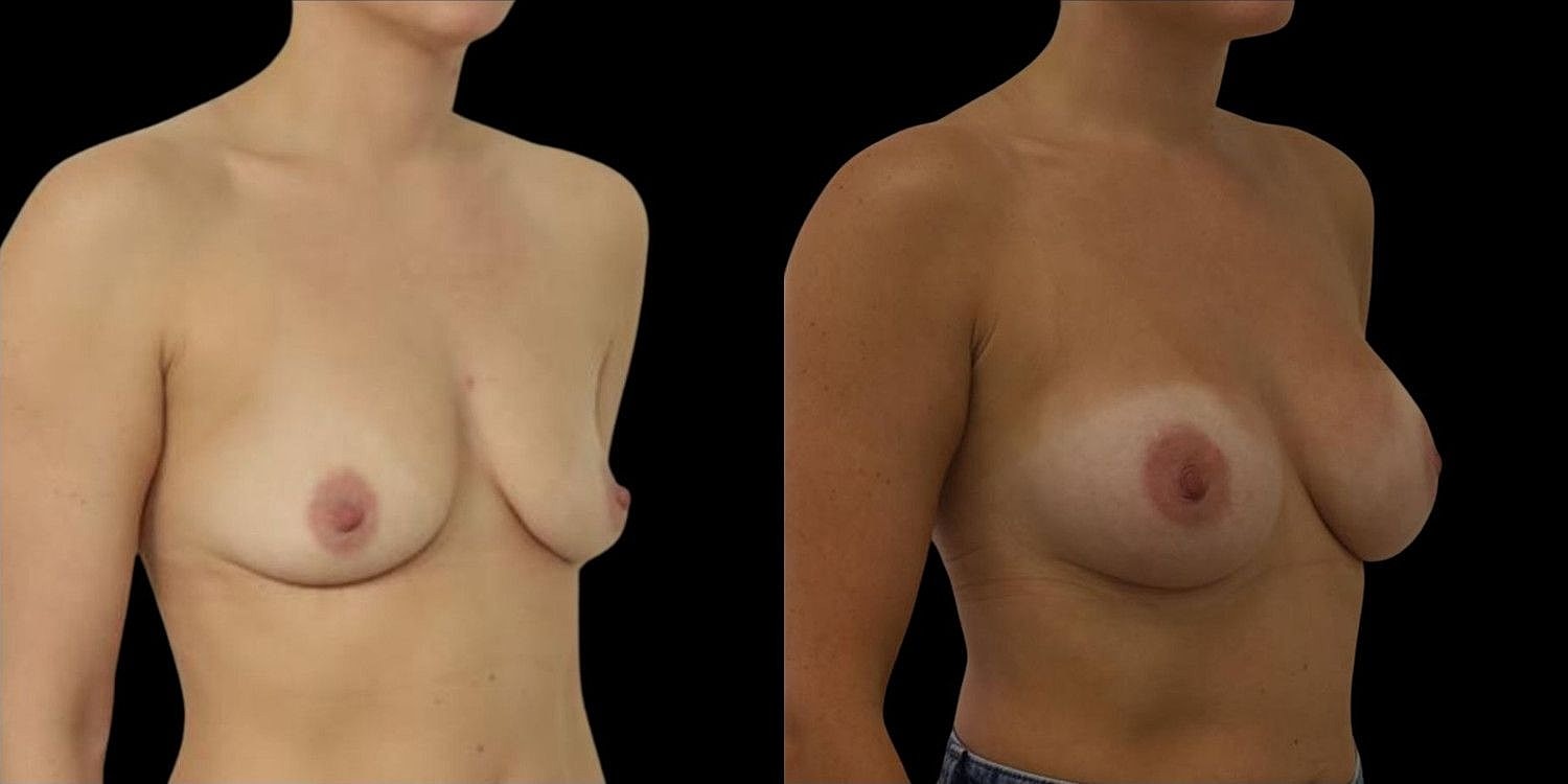 Motiva Breast Implants Before & After
