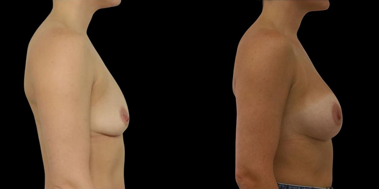 Motiva Breast Implants Before & After