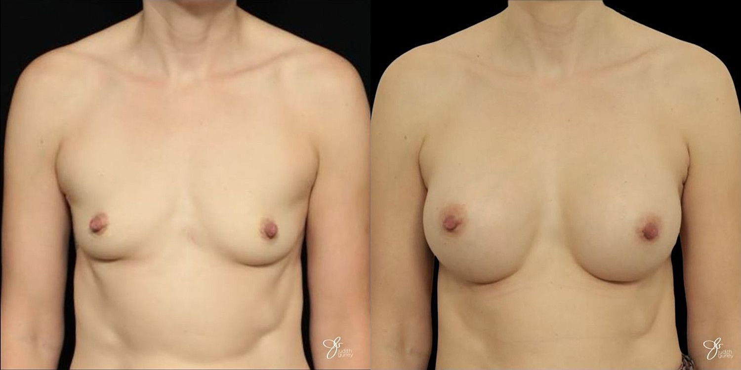 Motiva Breast Implants Before & After