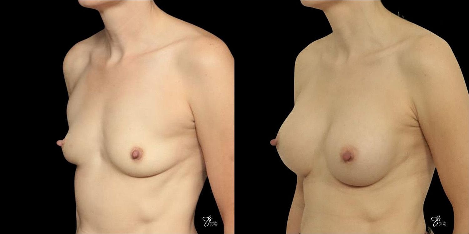 Motiva Breast Implants Before & After