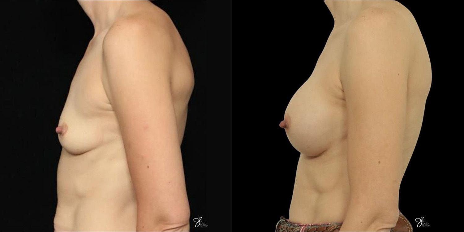 Motiva Breast Implants Before & After