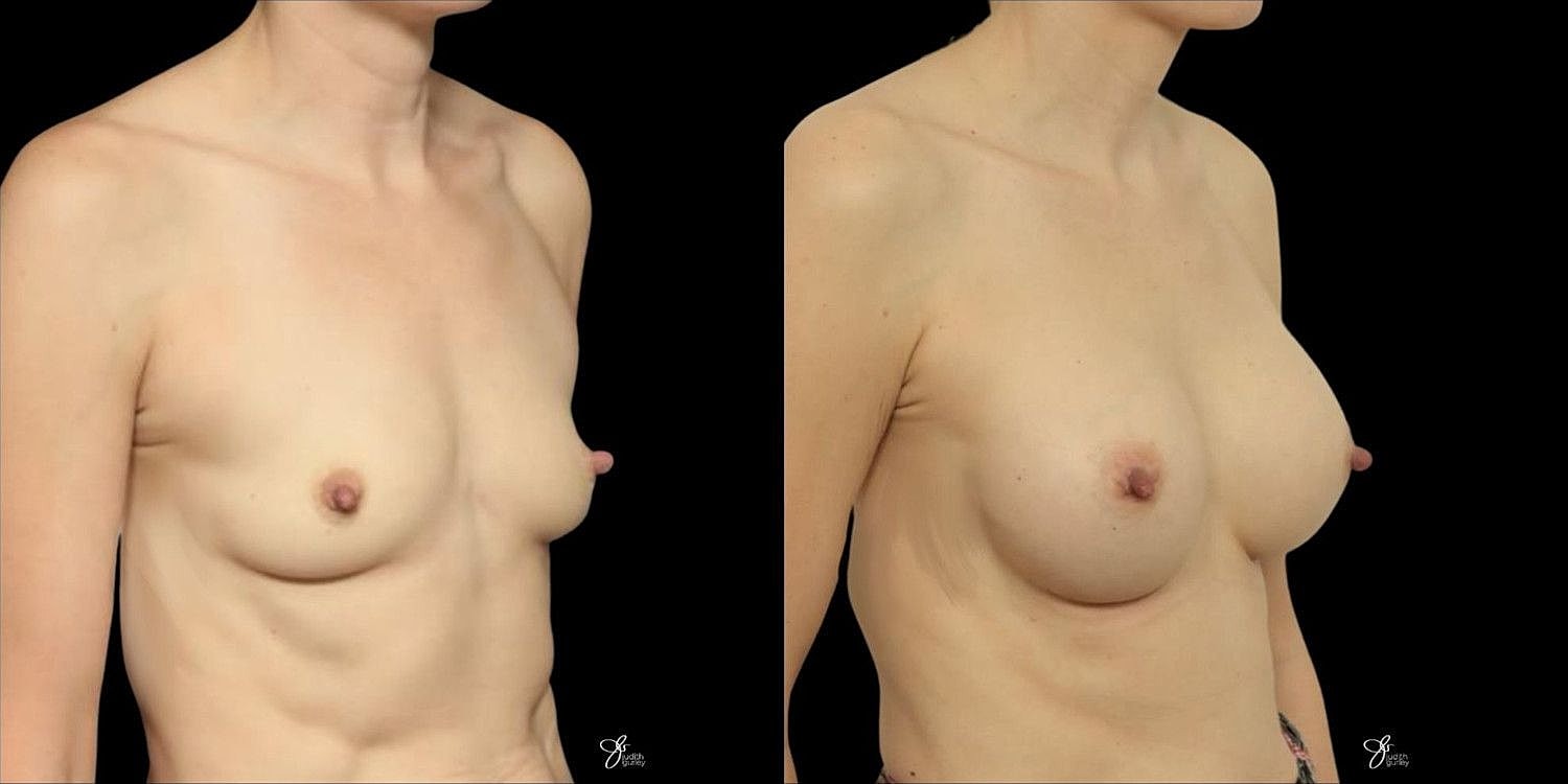 Motiva Breast Implants Before & After
