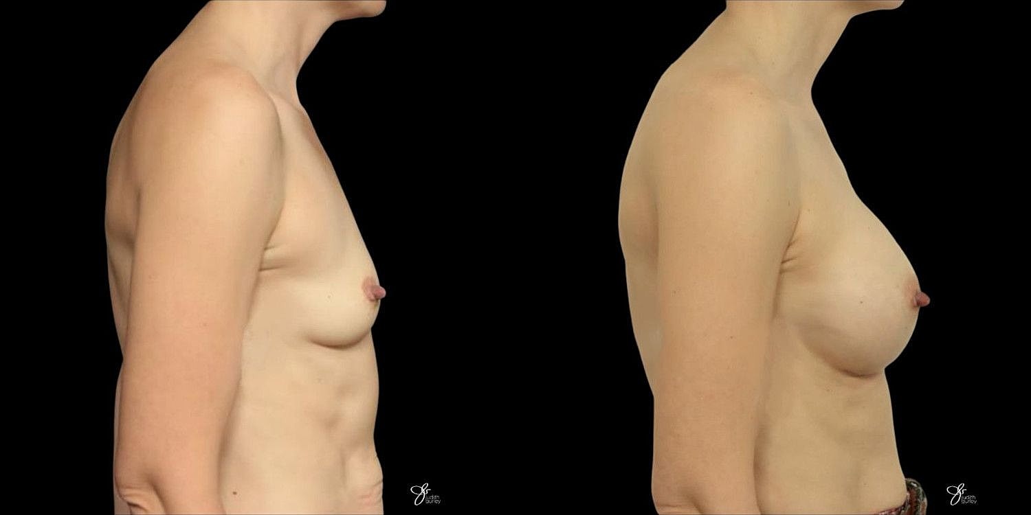 Motiva Breast Implants Before & After