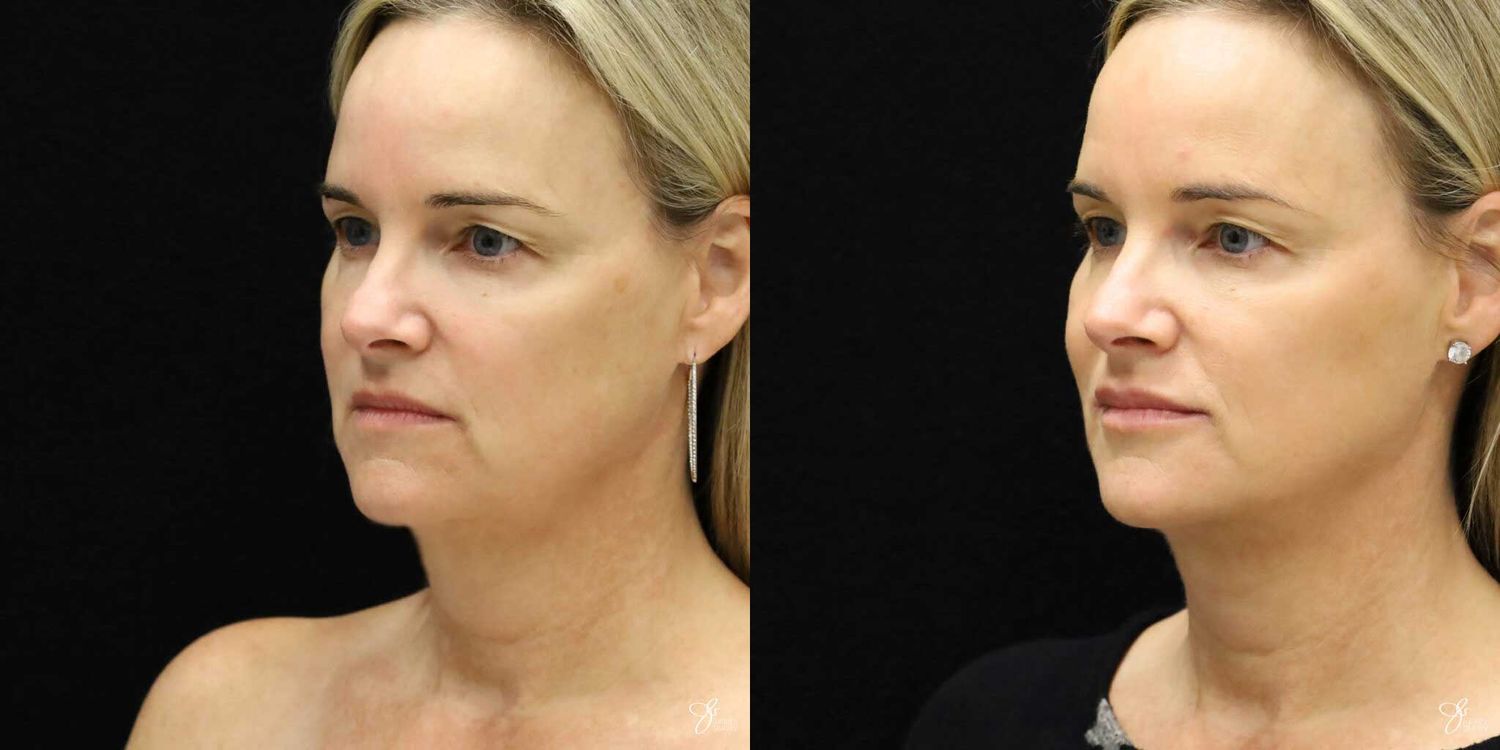 Neurotoxin Botox And Daxxify Before & After