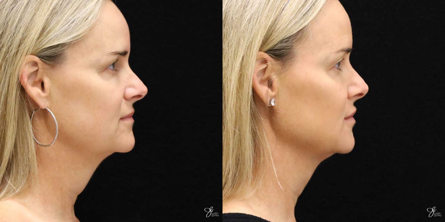 Neurotoxin Botox And Daxxify Before & After
