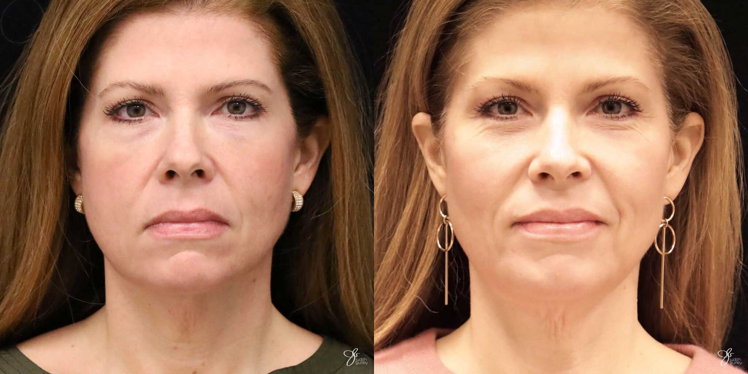 Neurotoxin Botox And Daxxify Before & After