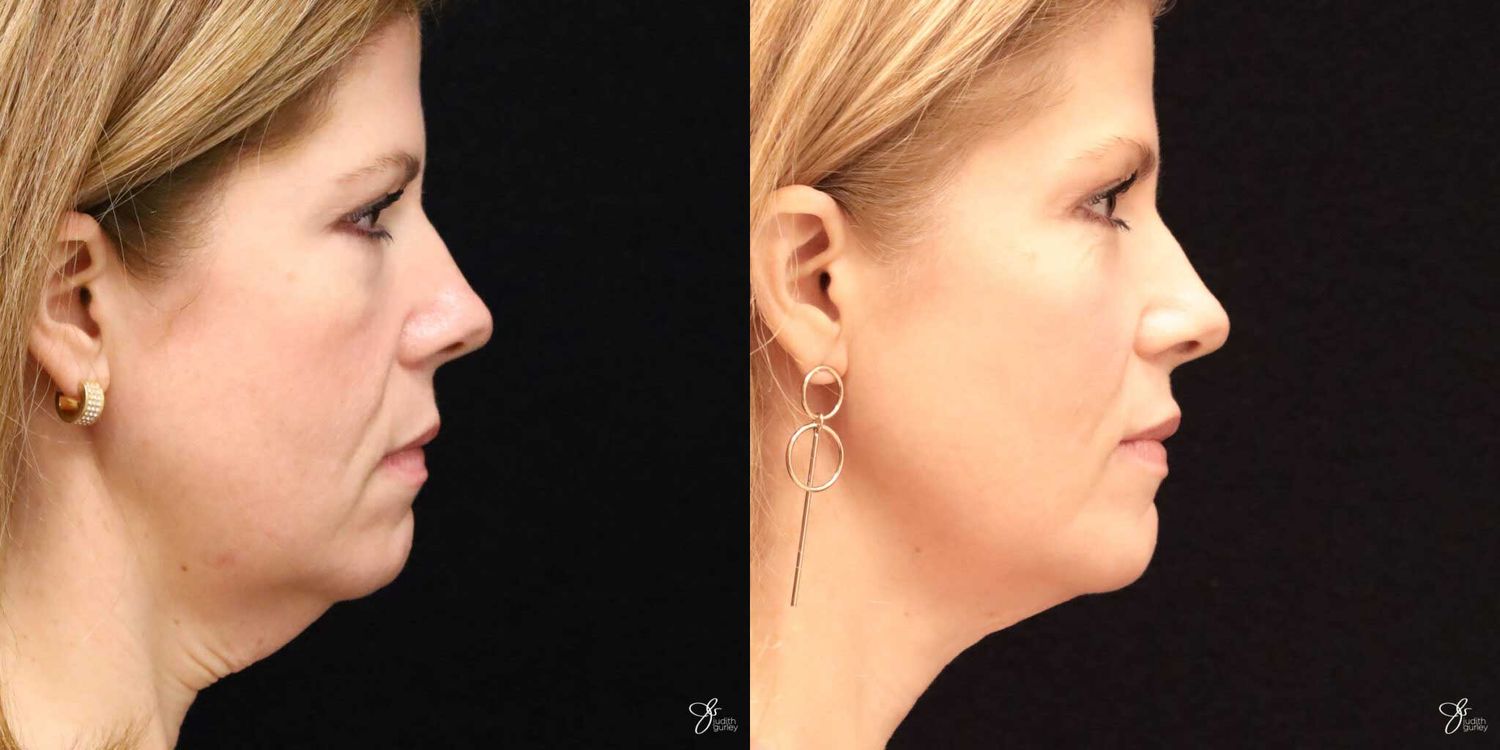 Neurotoxin Botox And Daxxify Before & After