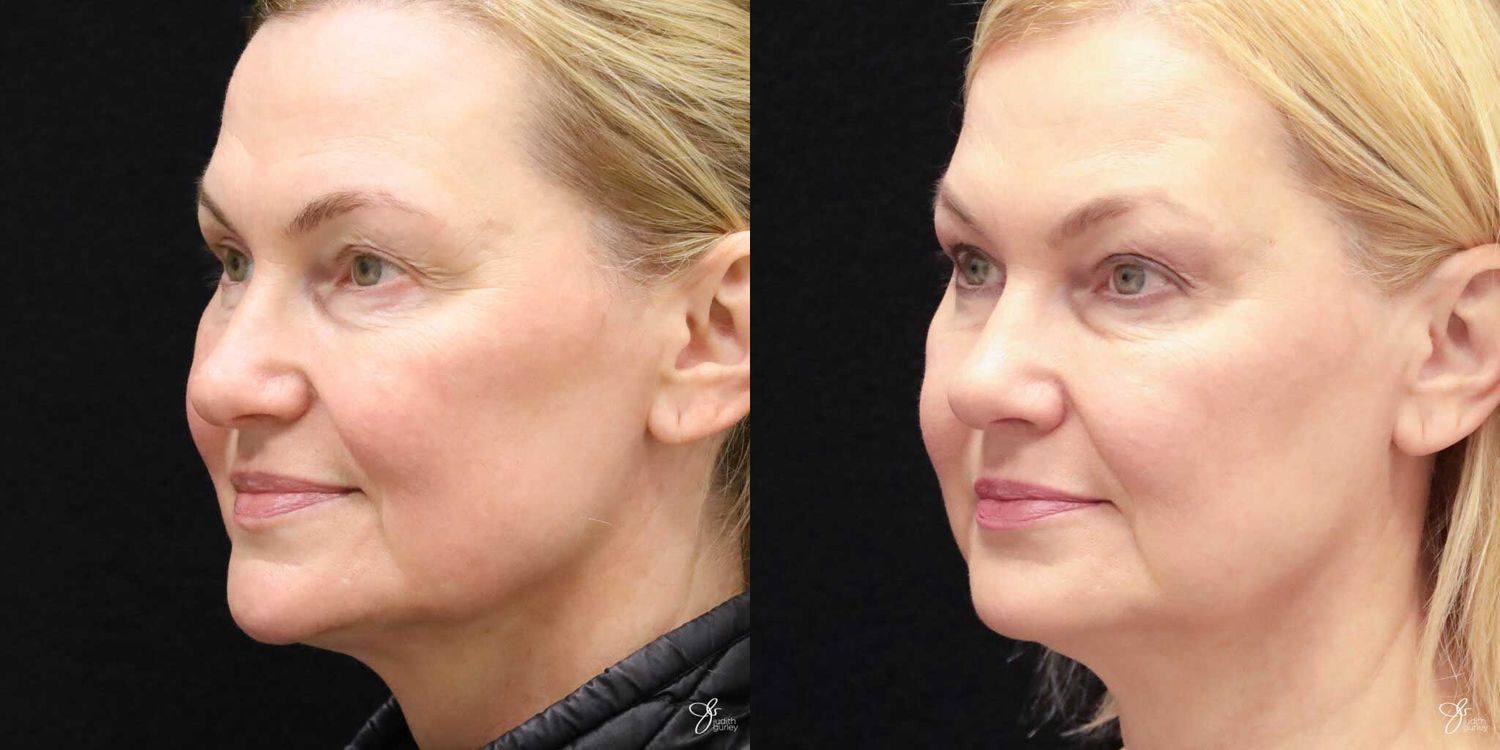 Neurotoxin Botox And Daxxify Before & After