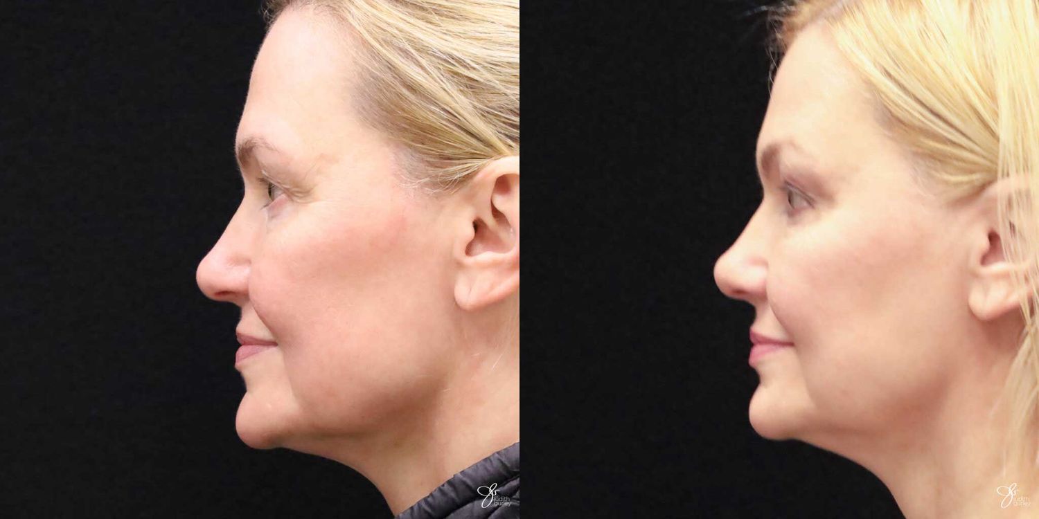 Neurotoxin Botox And Daxxify Before & After