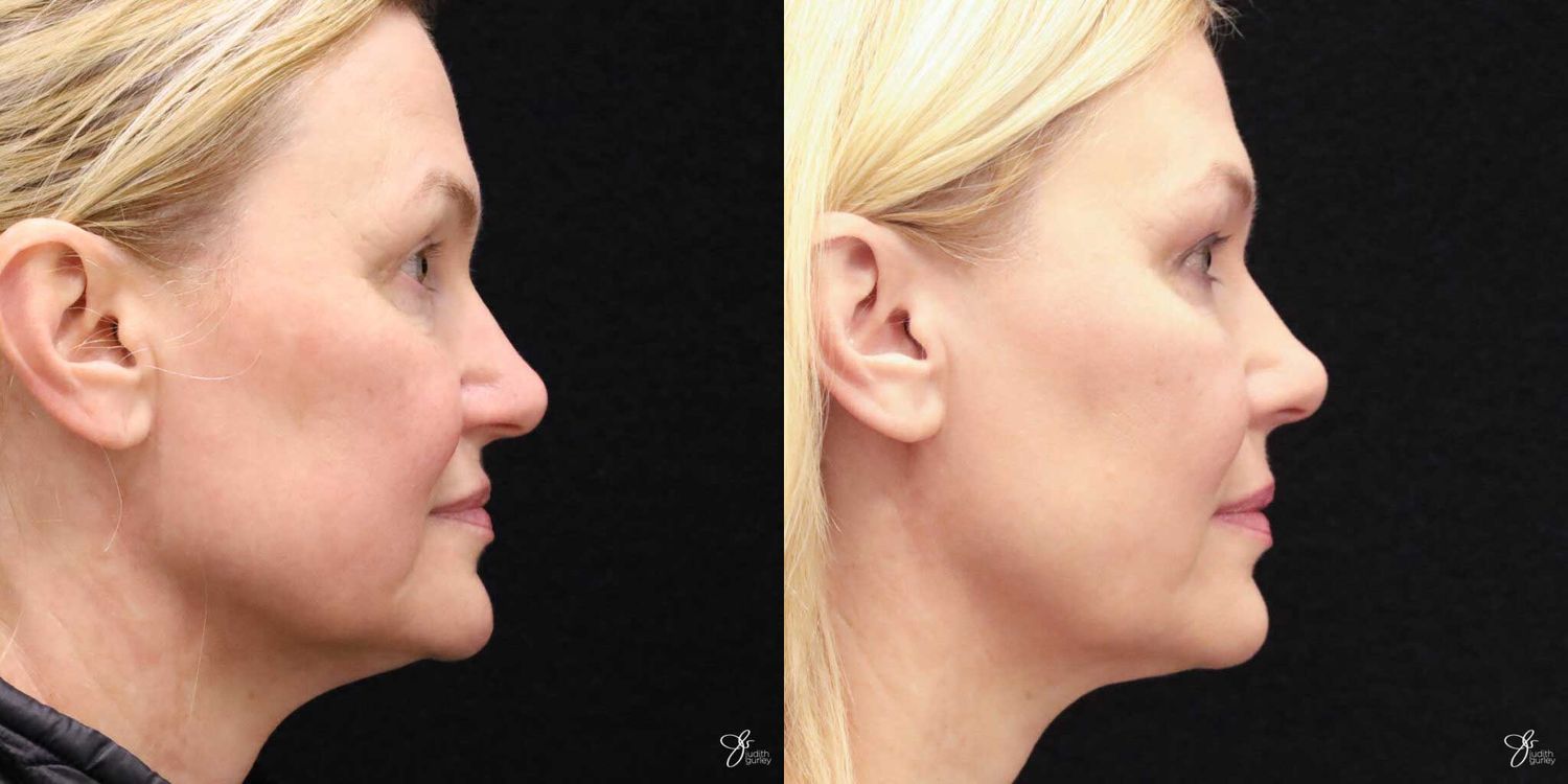 Neurotoxin Botox And Daxxify Before & After