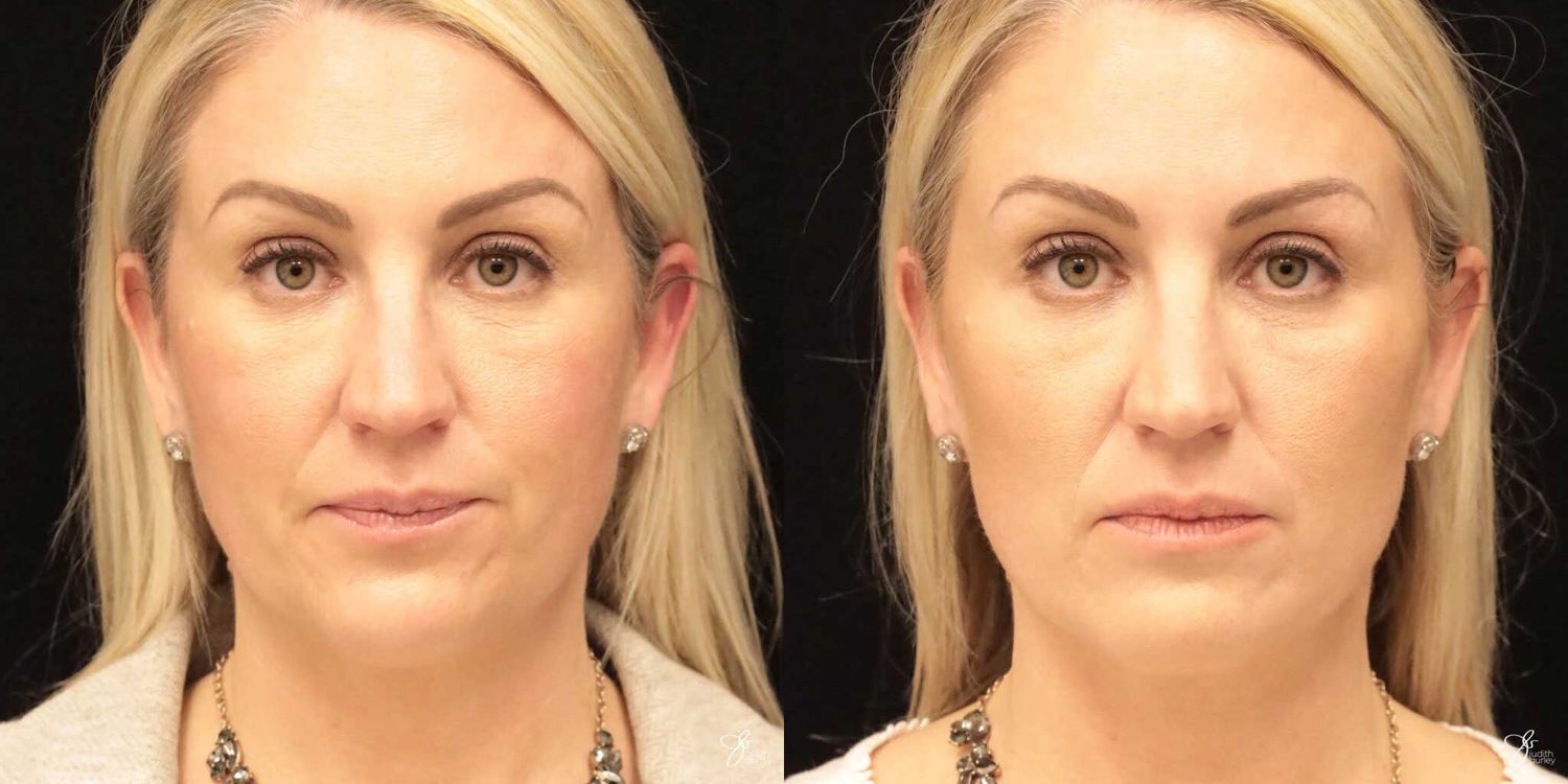Neurotoxin Botox And Daxxify Before & After