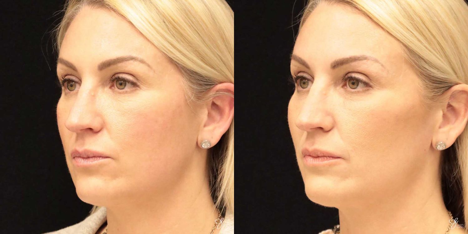 Neurotoxin Botox And Daxxify Before & After