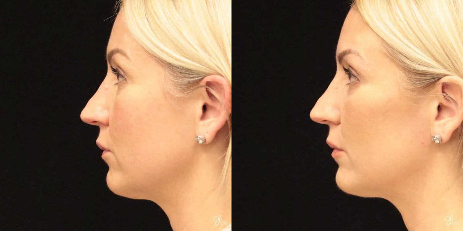 Neurotoxin Botox And Daxxify Before & After