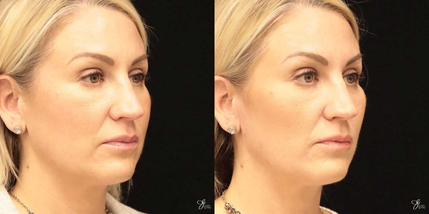 Neurotoxin Botox And Daxxify Before & After