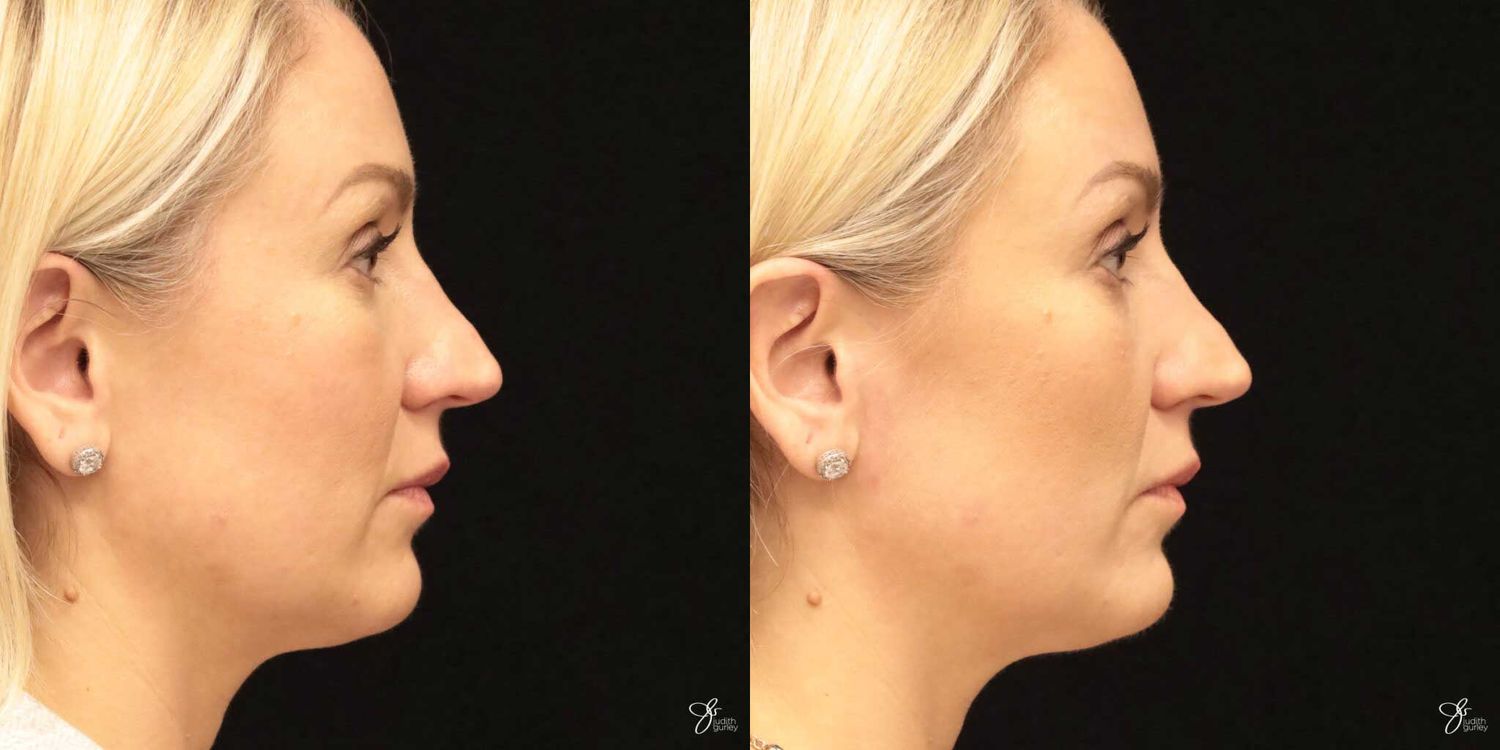 Neurotoxin Botox And Daxxify Before & After