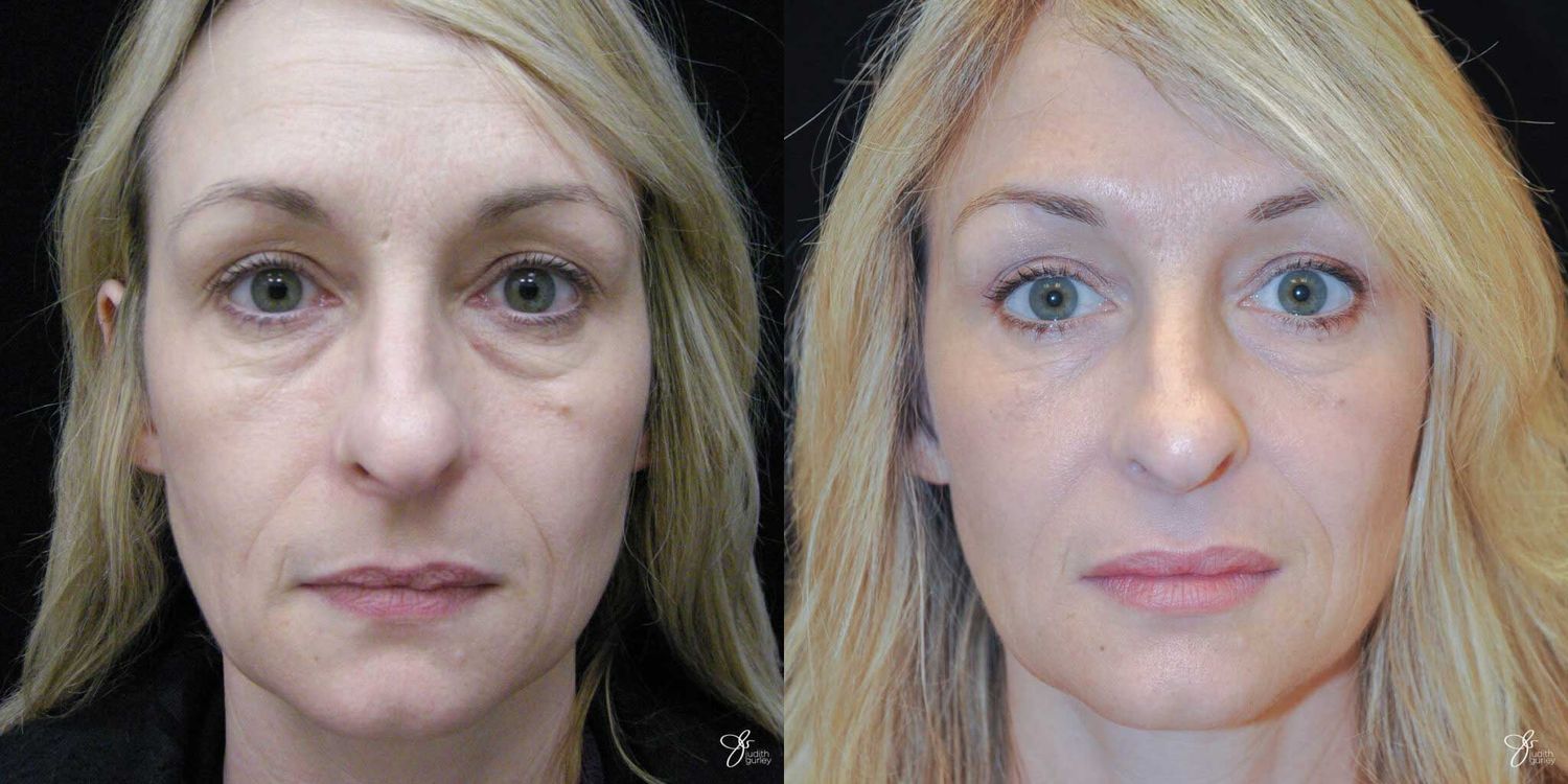 Neurotoxin Botox And Daxxify Before & After