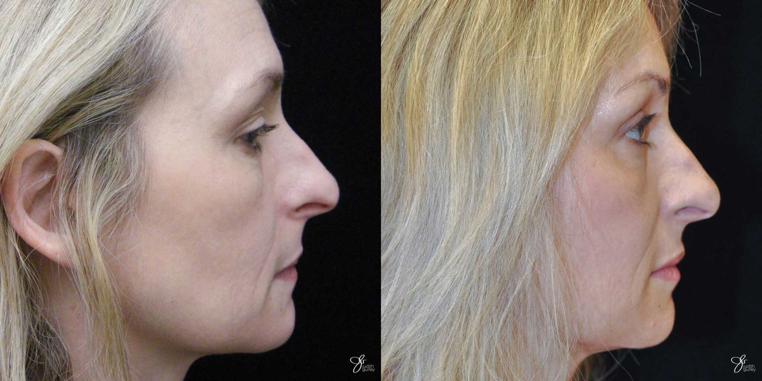 Neurotoxin Botox And Daxxify Before & After