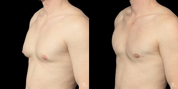 Gynecomastia Correction Before & After