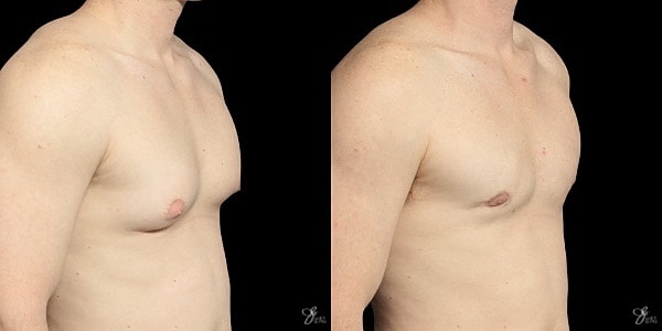 Gynecomastia Correction Before & After
