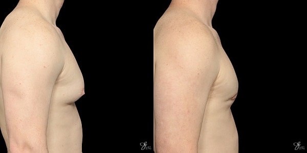 Gynecomastia Correction Before & After
