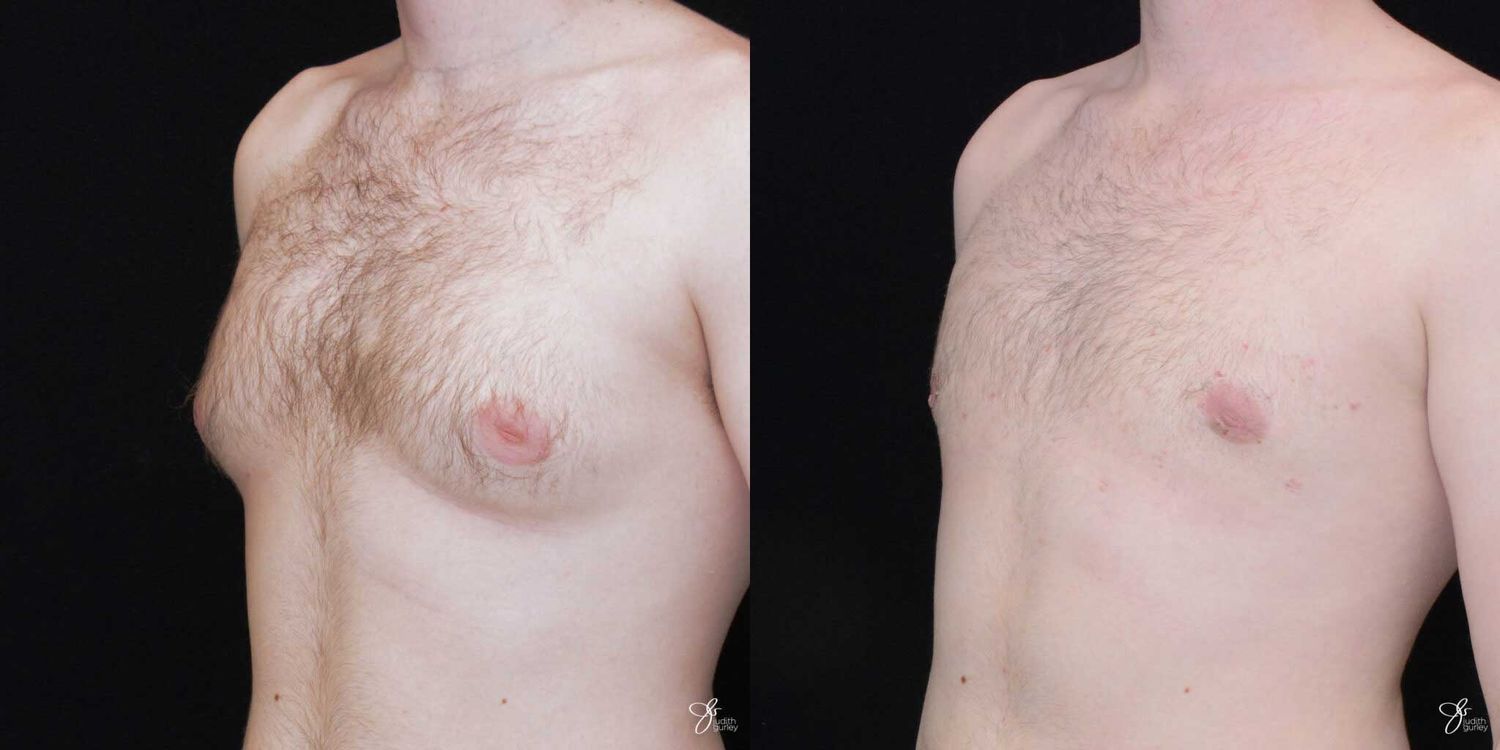 Gynecomastia Correction Before & After