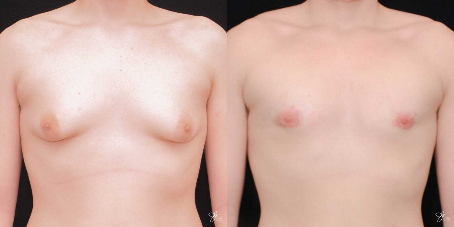Gynecomastia Correction Before & After