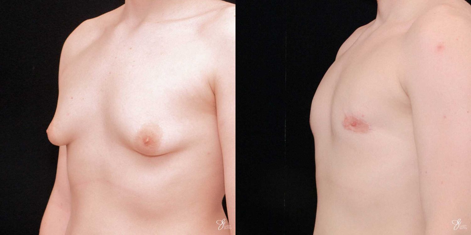 Gynecomastia Correction Before & After
