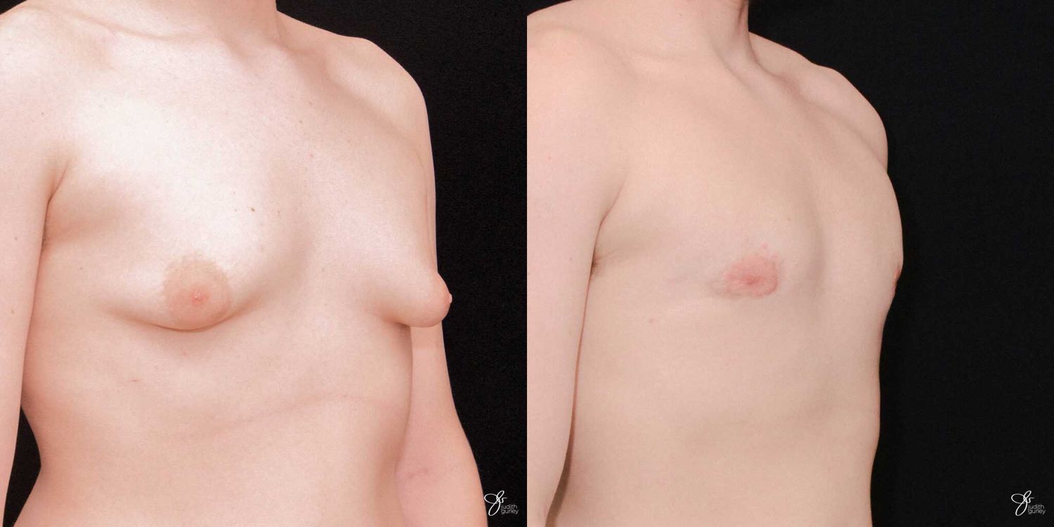 Gynecomastia Correction Before & After