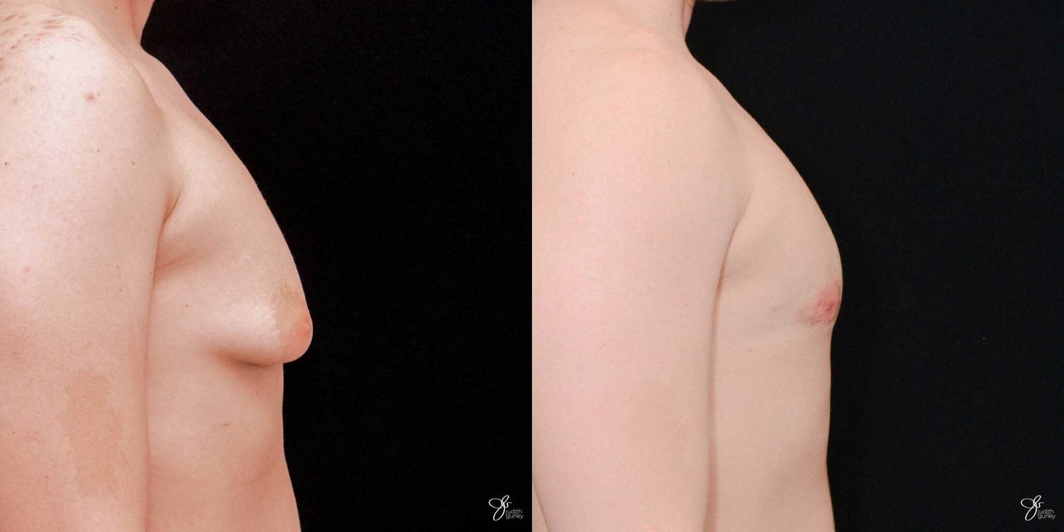 Gynecomastia Correction Before & After
